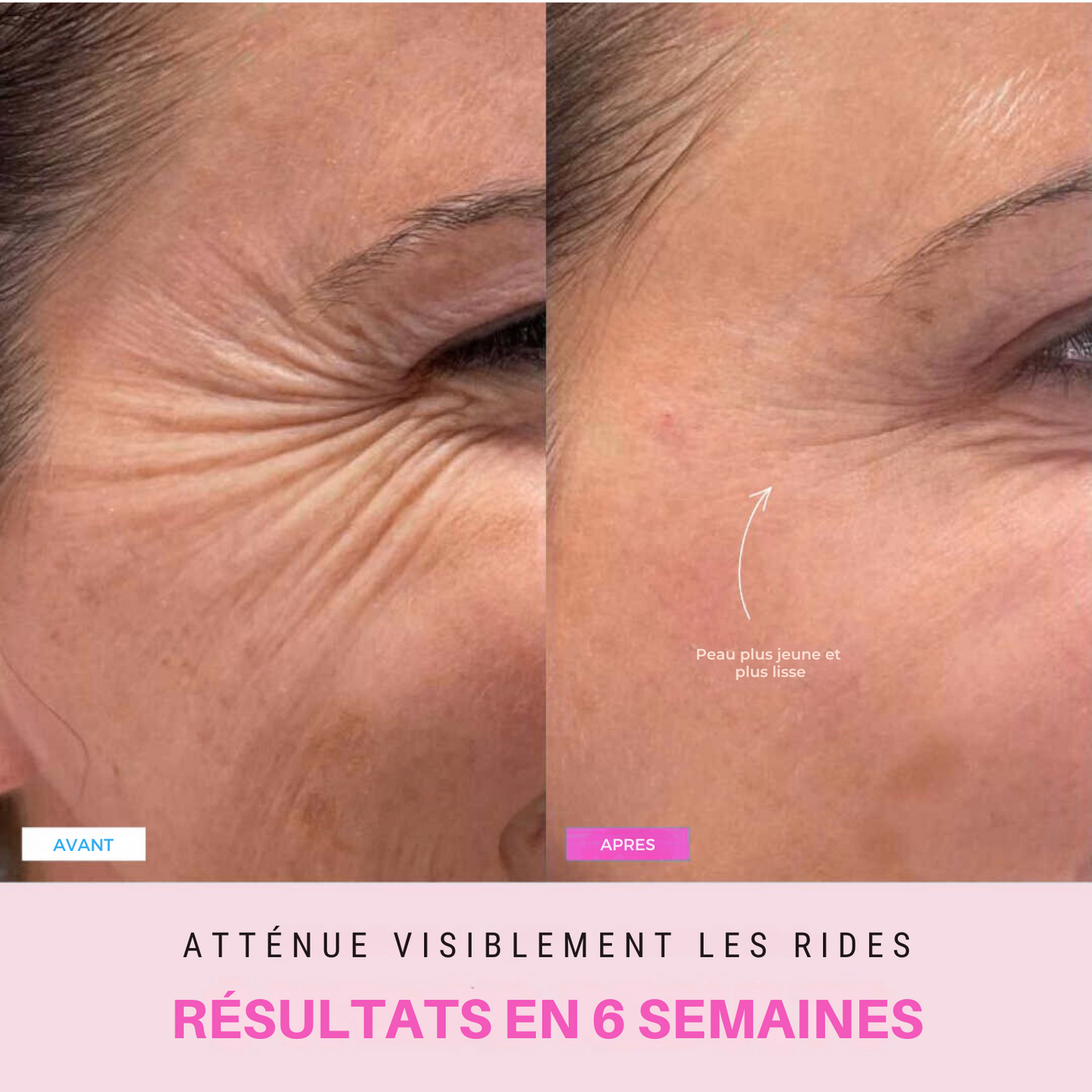 Appareil anti-ride + 2 Sérums OFFERTS
