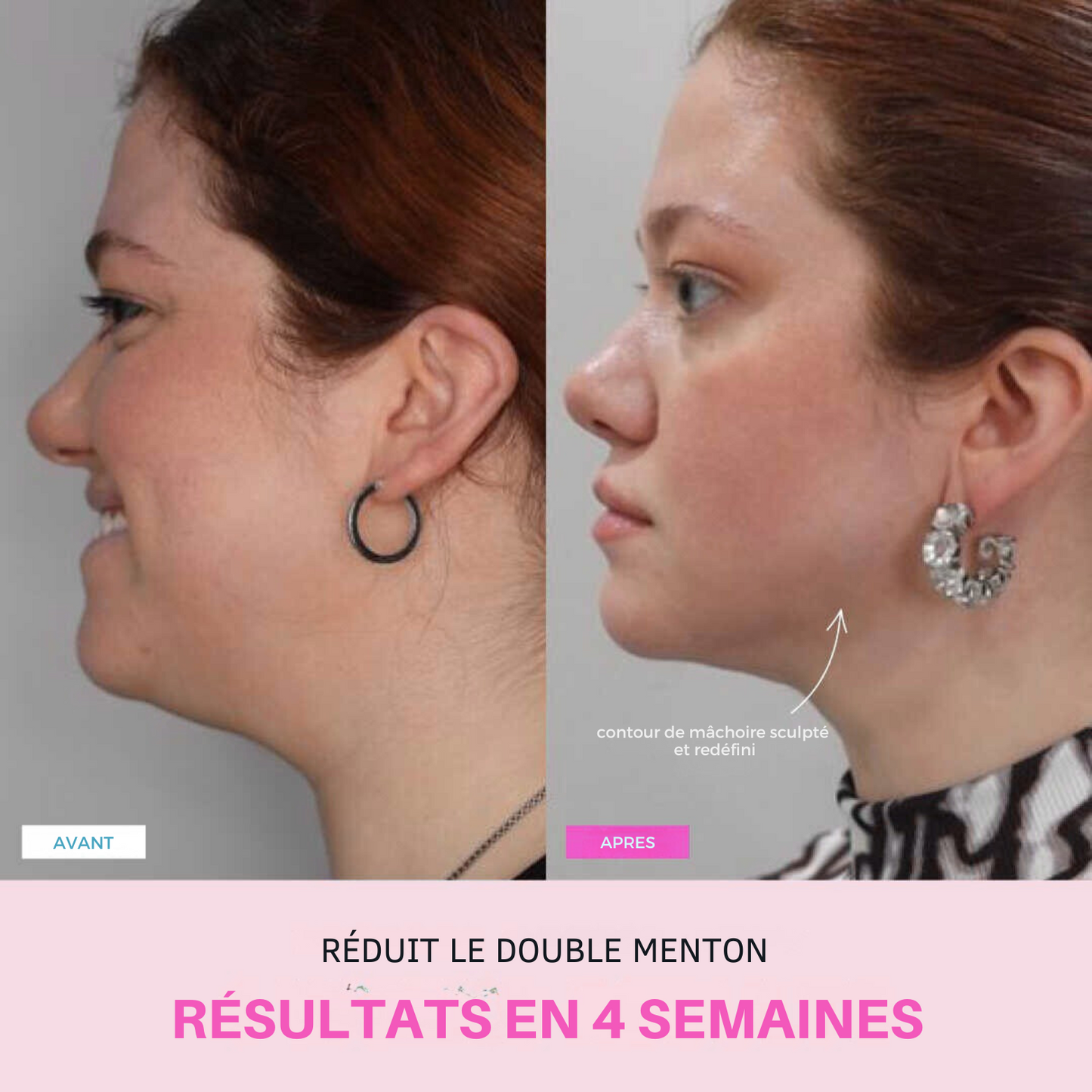 Appareil anti-ride + 2 Sérums OFFERTS